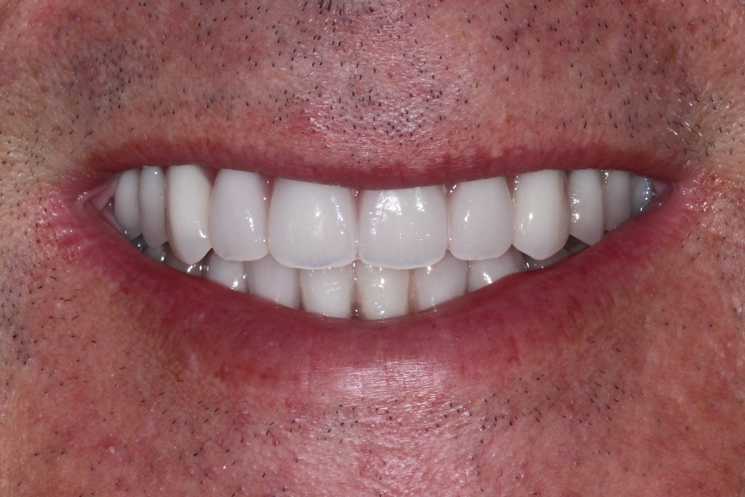 after implants teeth photo