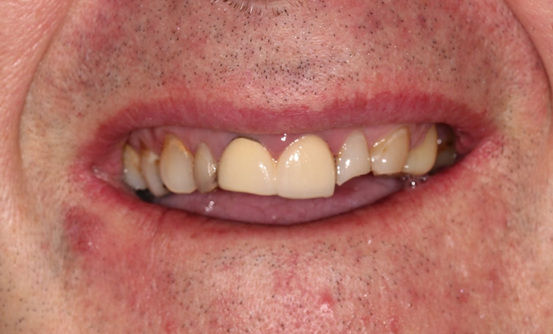 before implants teeth photo